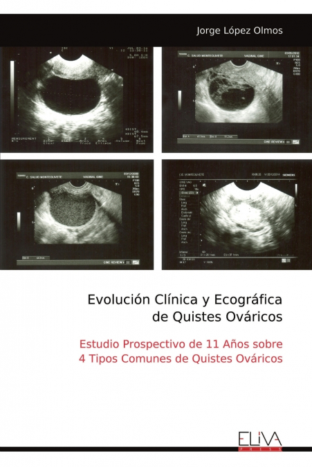 Evolución Clínica y Ecográfica de Quistes Ováricos