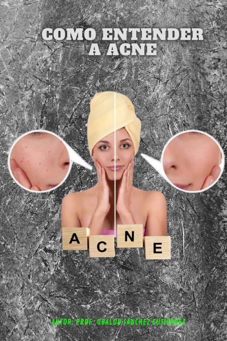 Como entender a acne