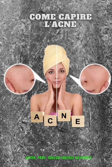 Come capire l’acne
