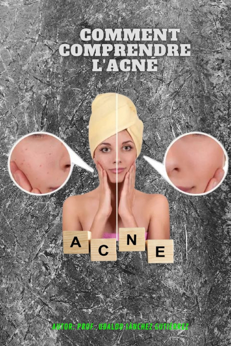 Comment comprendre l’acné